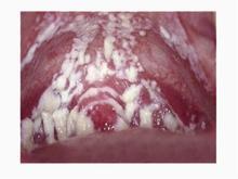 白带豆腐渣状图片-白带呈豆腐渣状图片是怎样的?-广州仁爱