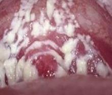 白带豆腐渣状图片是怎样的?-广州仁爱医院妇科